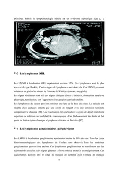 Aspects cliniques et classification des LMNH chez l'enfant