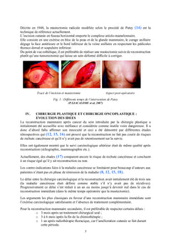 Cancer du Sein : Prothèses Mammaires