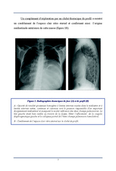 Imagerie du Thymolipome