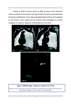 Imagerie du Thymolipome
