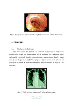 L'Achalasie
