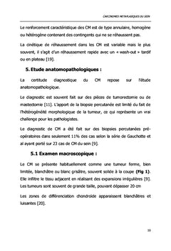 Carcinomes Métaplasiques du Sein