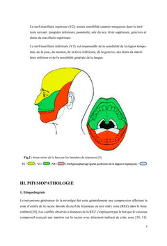 Névralgie faciale