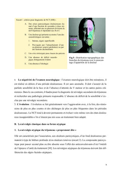 Névralgie faciale