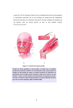 Traitement chirurgical de la paralysie faciale périphérique
