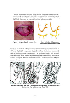 Traitement chirurgical de la paralysie faciale périphérique