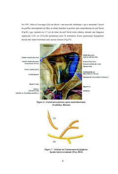 Traitement chirurgical de la paralysie faciale périphérique
