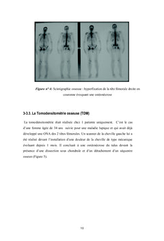 Les ostéonécroses aseptiques au cours du Lupus érythémateux systémique