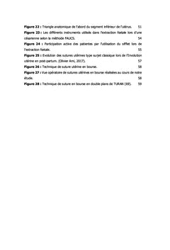 La cesarienne ambulatoire