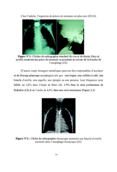 Les corps étrangers pharyngo-oesophagiens