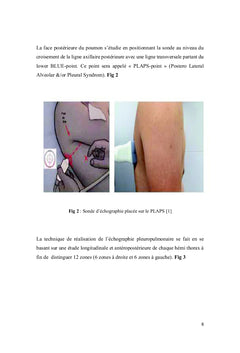 Echographie pleuropulmonaire chez le malade en état critique