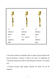 Le genou flottant : diagnostique et algorithme de prise en charge
