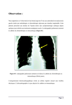 Collection myxomes: cas cliniques