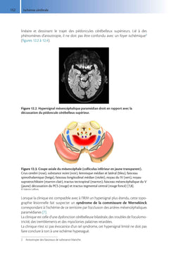 Imagerie de l'accident vasculaire cérébral ischémique aigu