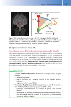 Imagerie de l'accident vasculaire cérébral ischémique aigu