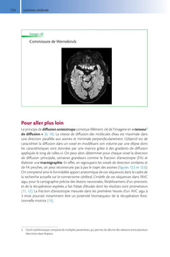 Imagerie de l'accident vasculaire cérébral ischémique aigu