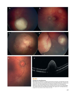 Rétine : atlas des maladies du fond d'oeil
