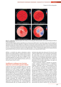 Insuffisance cardiaque