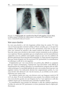 Accès vasculaires pour hémodialyse