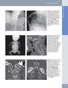 Imagerie médicale : Rachis