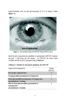 La maladie de la surface oculaire chez le glaucomateux