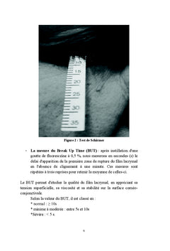La maladie de la surface oculaire chez le glaucomateux