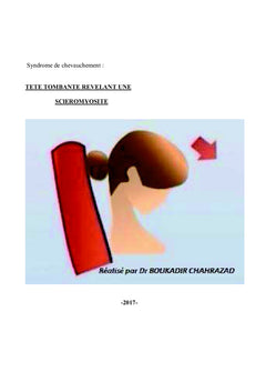 Tete tombante revelant une scleromyosite