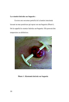 Les stomies digestives