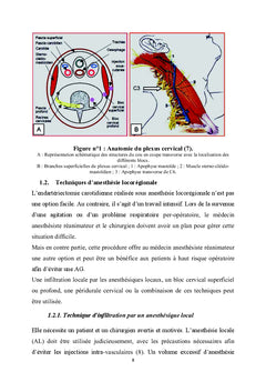 Anesthesie pour chirurgie de la carotide
