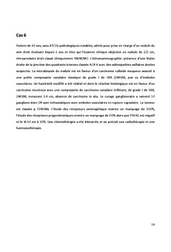 Cancer du sein chez l'homme