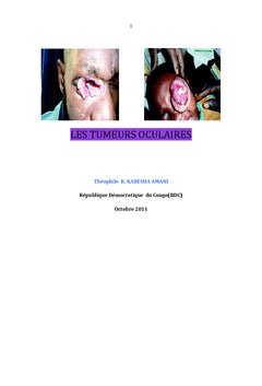 Les tumeurs oculaires