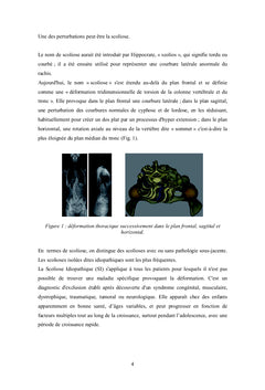 Impact de la scoliose idiopathique sur la marche chez l'adolescent