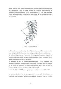 Impact de la scoliose idiopathique sur la marche chez l'adolescent
