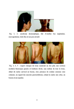 La fibrodysplasie ossifiante progrèssive