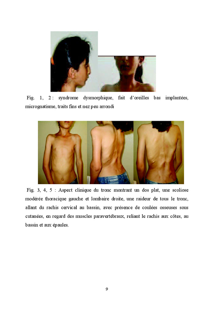 La fibrodysplasie ossifiante progrèssive