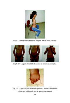 La fibrodysplasie ossifiante progrèssive