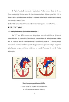 Le switch arteriel dans la transposition des gros vaisseaux