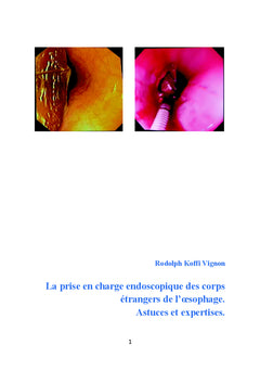 La prise en charge endoscopique des corps étrangers de l'oesophage