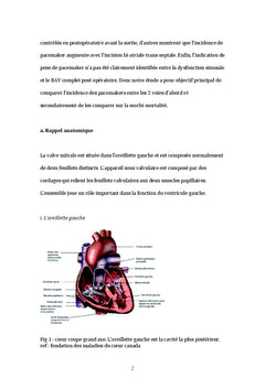 Comparaison de la voie de Guiraudon et du sillon de Sondergaard