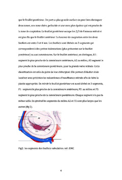 Comparaison de la voie de Guiraudon et du sillon de Sondergaard