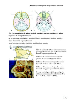 Rhinorrhee cerebrospinale diagnostic et traitement