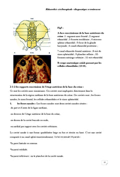 Rhinorrhee cerebrospinale diagnostic et traitement