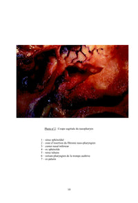 Le fibrome nasopharyngien