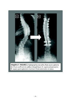 Monitorage Neurophysiologique pendant les chirurgies du rachis
