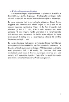 Le coeur carcinoide