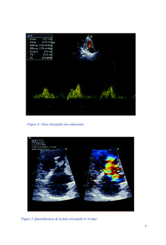 Le coeur carcinoide
