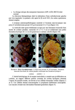 Tumeurs neuroendocrines du testicule: revue de la litterature