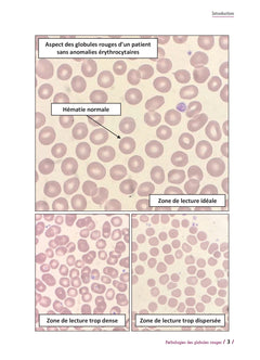 Pathologies des globules rouges