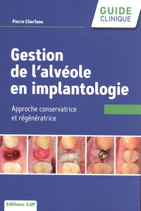 Gestion de l'alvéole en implantologie