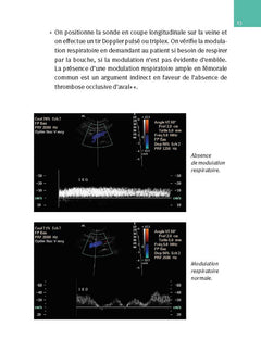 Échographie doppler vasculaire
